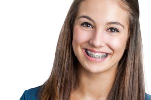 How Long Will You Be in Braces?